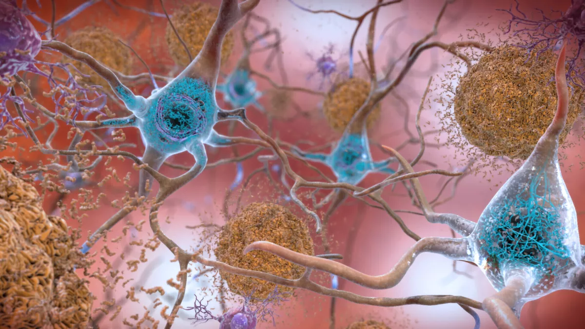 New Alzheimer’s drugs are costly and controversial. Are we going about this all wrong?